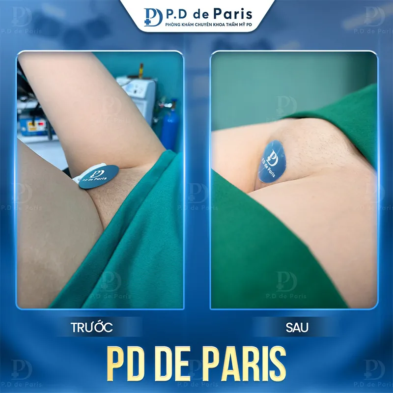 Cấy mỡ môi lớn kiêng ăn gì và nên ăn gì để vết thương mau lành?